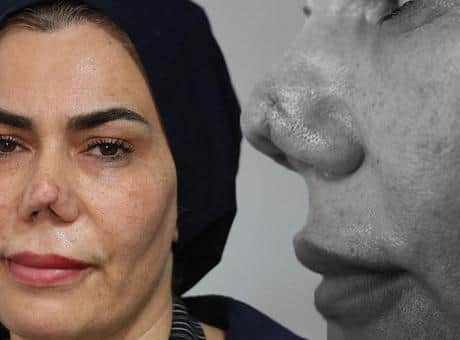 Burnu kırıldı, 4 operasyon sonrası hayatı kabusa döndü: Resmen hayattan koptum