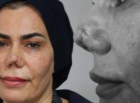 Burnu kırıldı, 4 operasyon sonrası hayatı kabusa döndü: Resmen hayattan koptum