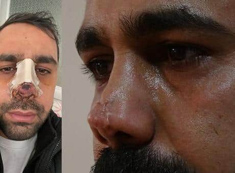 Burun ameliyatı sonrası hayatı kabusa döndü! 40 bin avroluk tedavi çıktı Burun ameliyatı sonrası hayatı kabusa döndü! 40 bin avroluk tedavi çıktı