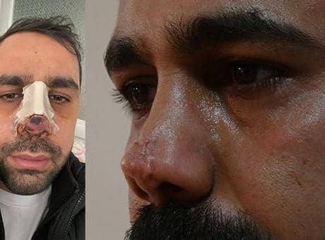 Burun ameliyatı sonrası hayatı kabusa döndü! 40 bin avroluk tedavi çıktı Burun ameliyatı sonrası hayatı kabusa döndü! 40 bin avroluk tedavi çıktı