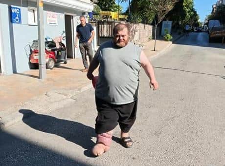 4 yıldır fil hastalığıyla mücadele ediyor! Yürümek için 82 kilo vermesi gerekiyor 4 yıldır fil hastalığıyla mücadele ediyor! Yürümek için 82 kilo vermesi gerekiyor
